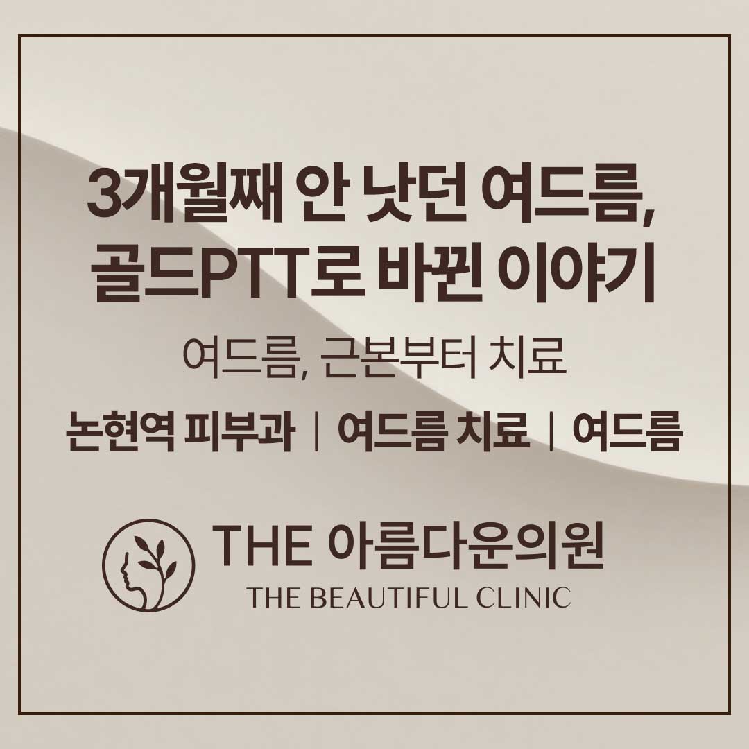 여드름, 여드름치료, 강남역 피부과, 포텐자, 여드름흉터치료, 여드름치료부작용, 여드름부작용, 여드름치료효과, 여드름치료주기, 여드름나는이유, 논현역피부과, 논현동피부과, 더아름다운의원, 여드름치료병원, 여드름치료부작용, 골드PTT, 골드피티티, 아그네스, 브이빔퍼펙타, 브이빔 